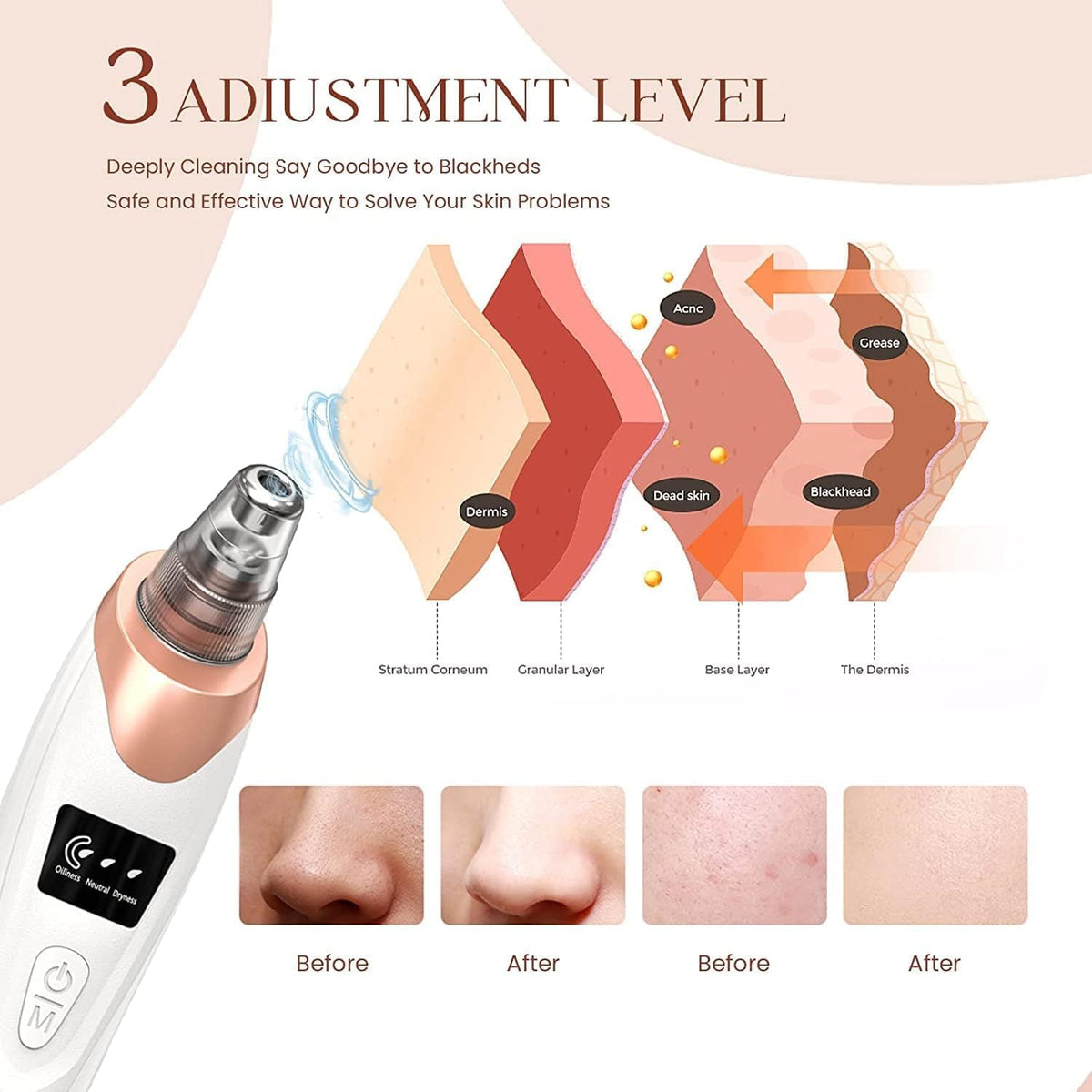 Ultimate 2026 Blackhead Remover Pore Vacuum - Rechargeable Facial Cleaner with 5 Suction Levels & Probes for All Skin Types